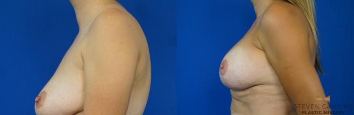 Before & After Breast Lift (Breast Mastopexy with Implants) Case 169 View #3 View in Fort Worth & Arlington, Texas