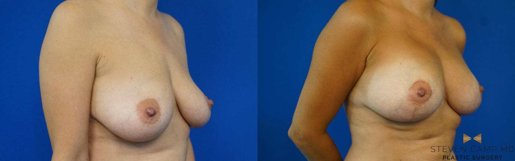 Before & After Breast Lift (Breast Mastopexy with Implants) Case 169 View #4 View in Fort Worth & Arlington, Texas