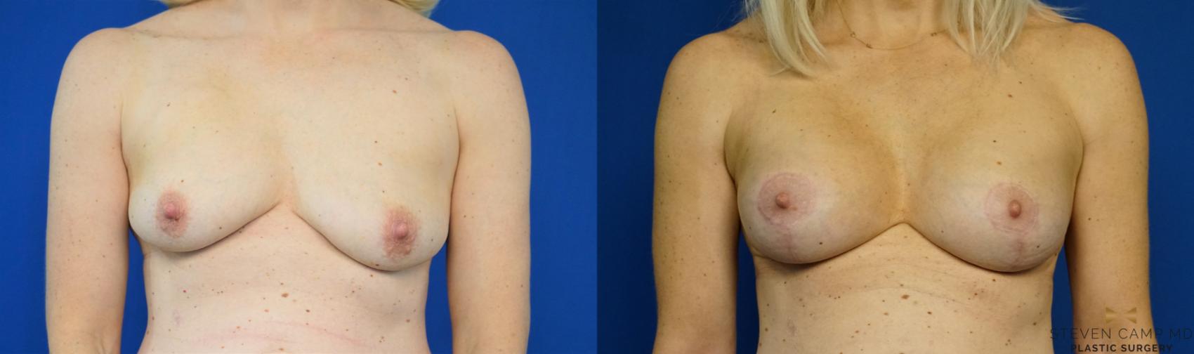 Before & After Breast Lift (Breast Mastopexy with Implants) Case 208 View #1 View in Fort Worth & Arlington, Texas