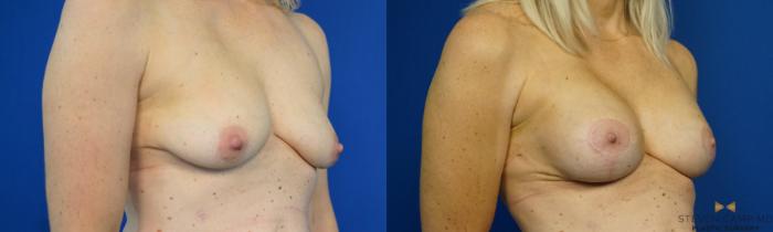 Before & After Breast Lift (Breast Mastopexy with Implants) Case 208 View #2 View in Fort Worth & Arlington, Texas