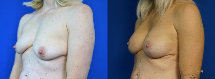 Before & After Breast Lift (Breast Mastopexy with Implants) Case 208 View #3 View in Fort Worth & Arlington, Texas
