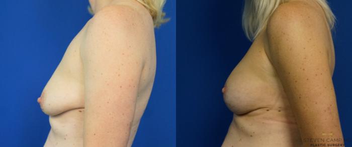 Before & After Breast Lift (Breast Mastopexy with Implants) Case 208 View #4 View in Fort Worth & Arlington, Texas