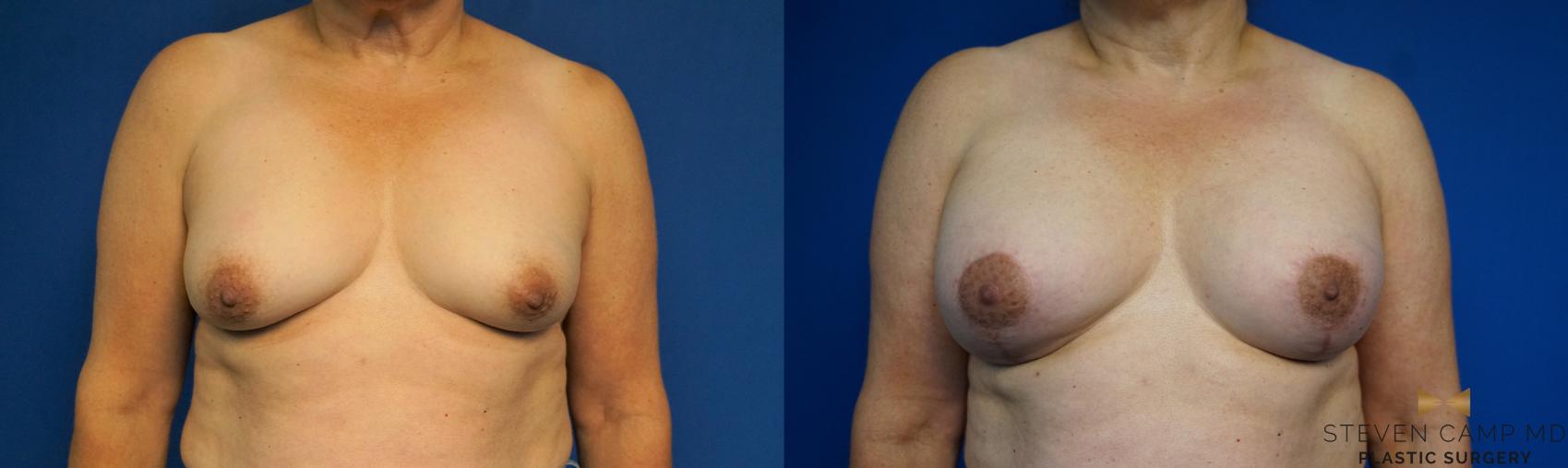 Before & After Breast Lift (Breast Mastopexy with Implants) Case 212 View #1 View in Fort Worth & Arlington, Texas
