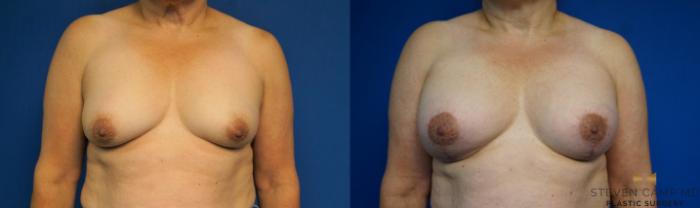 Before & After Breast Lift (Breast Mastopexy with Implants) Case 212 View #1 View in Fort Worth & Arlington, Texas
