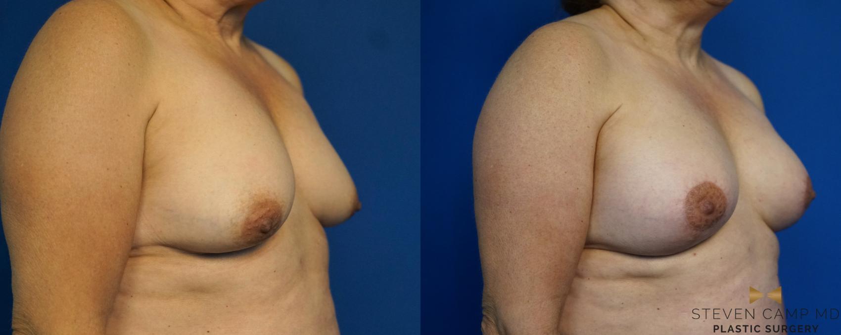 Before & After Breast Lift (Breast Mastopexy with Implants) Case 212 View #2 View in Fort Worth & Arlington, Texas