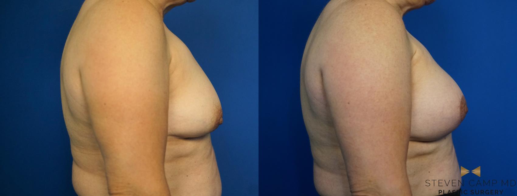 Before & After Breast Lift (Breast Mastopexy with Implants) Case 212 View #3 View in Fort Worth & Arlington, Texas