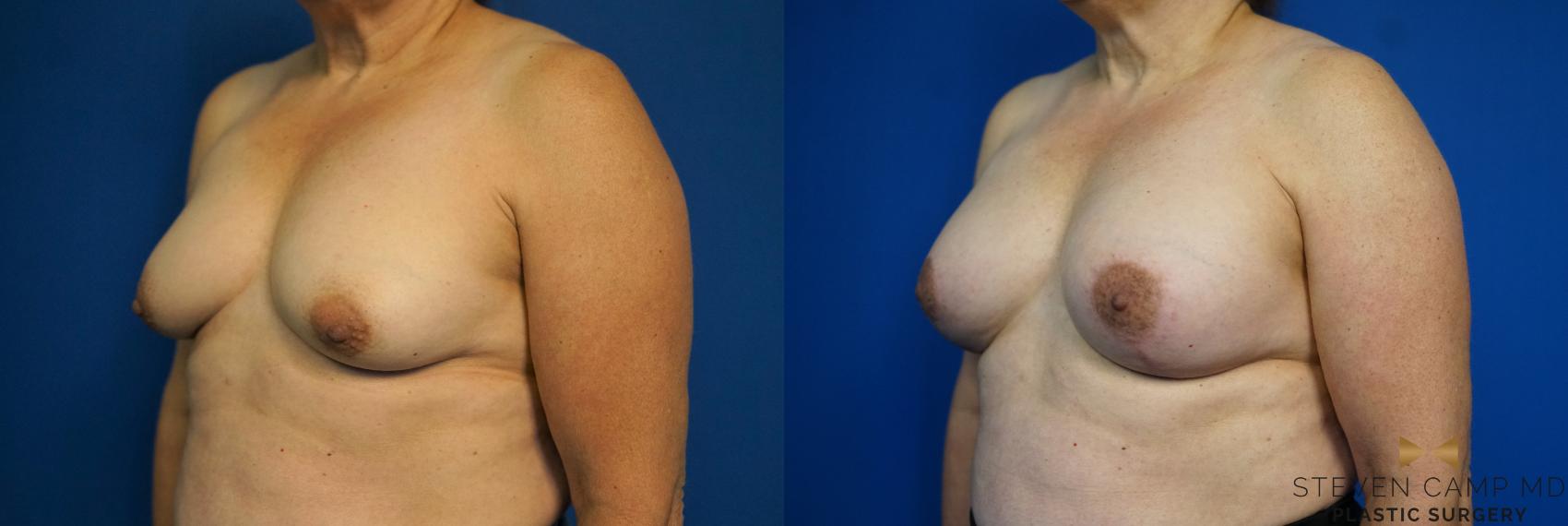 Before & After Breast Lift (Breast Mastopexy with Implants) Case 212 View #4 View in Fort Worth & Arlington, Texas