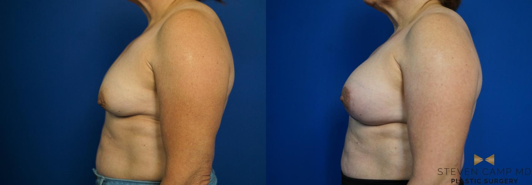 Before & After Breast Lift (Breast Mastopexy with Implants) Case 212 View #5 View in Fort Worth & Arlington, Texas