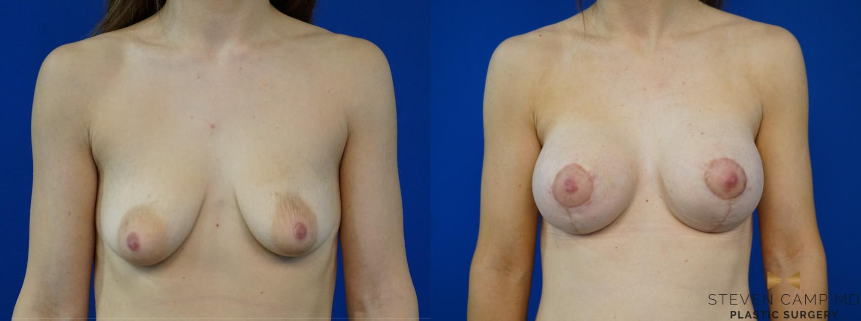 Before & After Breast Lift (Breast Mastopexy with Implants) Case 213 View #1 View in Fort Worth & Arlington, Texas