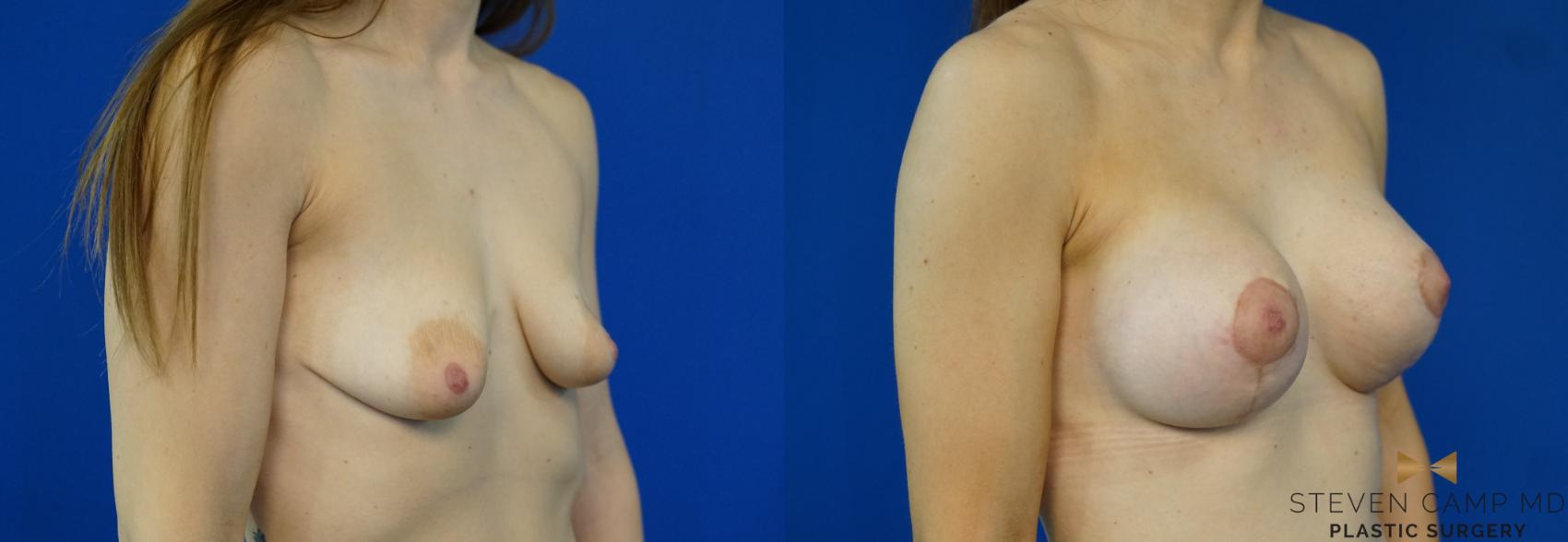 Before & After Breast Lift (Breast Mastopexy with Implants) Case 213 View #2 View in Fort Worth & Arlington, Texas