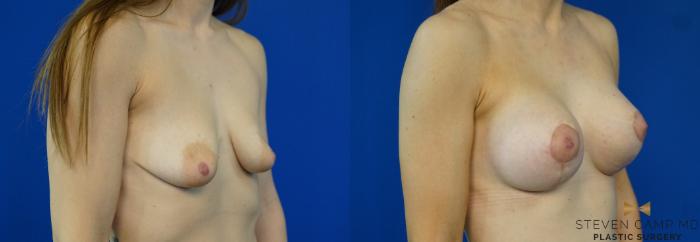 Before & After Breast Lift (Breast Mastopexy with Implants) Case 213 View #2 View in Fort Worth & Arlington, Texas