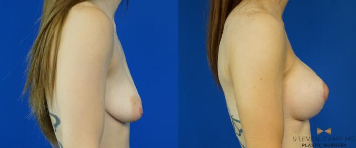 Before & After Breast Lift (Breast Mastopexy with Implants) Case 213 View #3 View in Fort Worth & Arlington, Texas