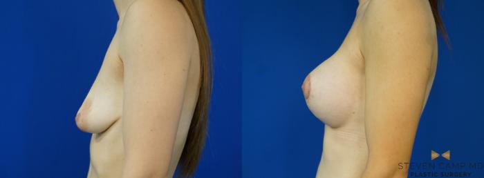 Before & After Breast Lift (Breast Mastopexy with Implants) Case 213 View #5 View in Fort Worth & Arlington, Texas