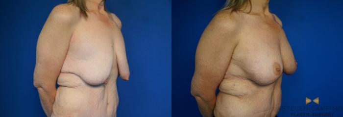 Before & After Breast Lift (Breast Mastopexy with Implants) Case 214 View #2 View in Fort Worth & Arlington, Texas