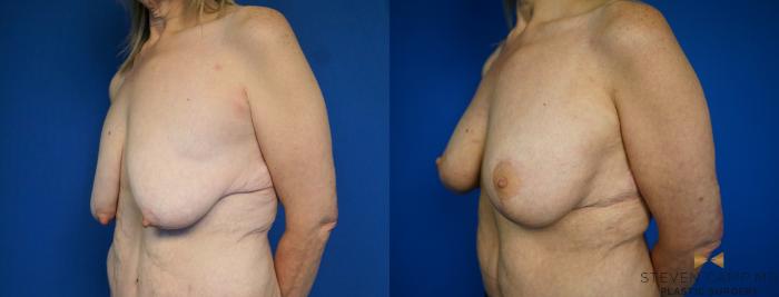 Before & After Breast Lift (Breast Mastopexy with Implants) Case 214 View #4 View in Fort Worth & Arlington, Texas