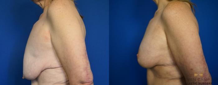 Before & After Breast Lift (Breast Mastopexy with Implants) Case 214 View #5 View in Fort Worth & Arlington, Texas
