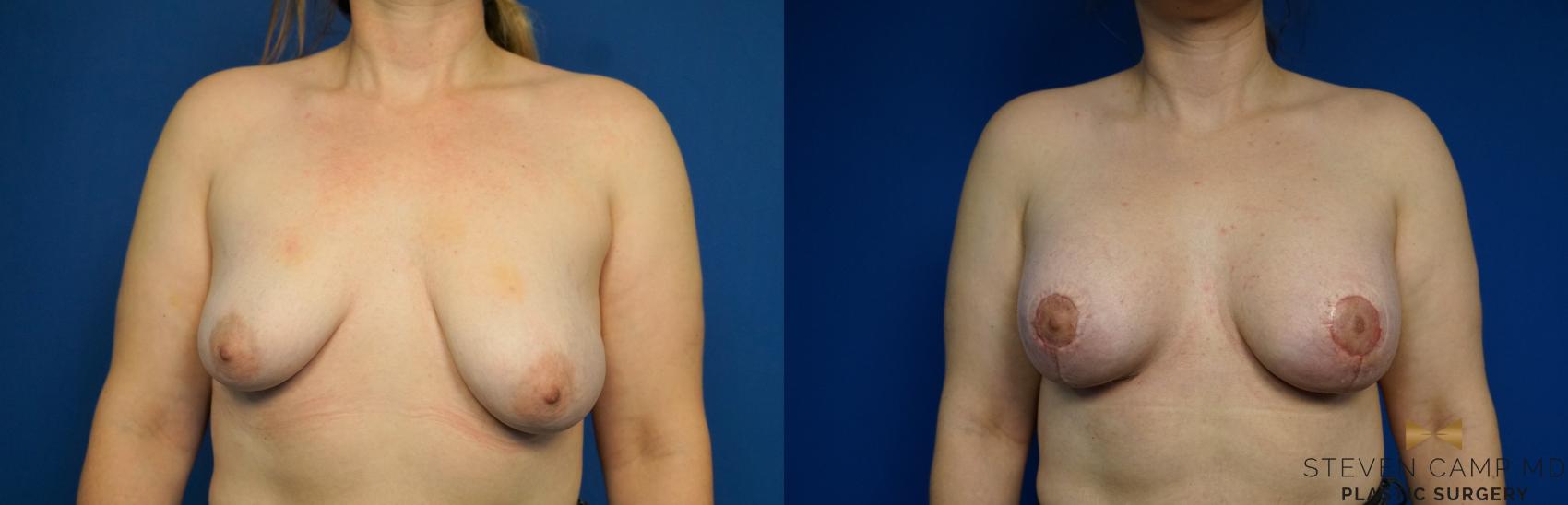 Before & After Breast Lift (Breast Mastopexy with Implants) Case 217 View #1 View in Fort Worth & Arlington, Texas