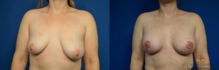 Before & After Breast Lift (Breast Mastopexy with Implants) Case 217 View #1 View in Fort Worth & Arlington, Texas