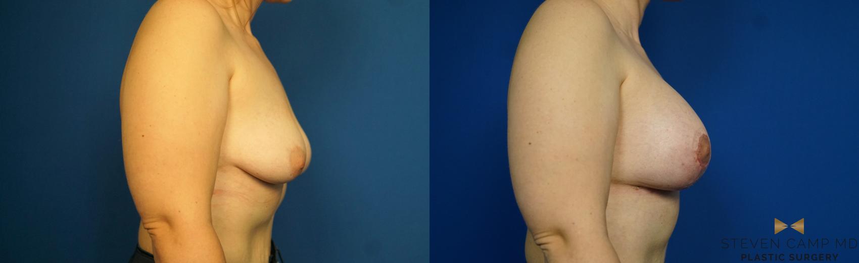Before & After Breast Lift (Breast Mastopexy with Implants) Case 217 View #2 View in Fort Worth & Arlington, Texas