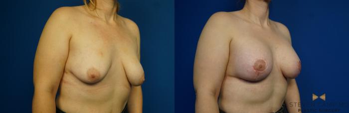 Before & After Breast Lift (Breast Mastopexy with Implants) Case 217 View #3 View in Fort Worth & Arlington, Texas