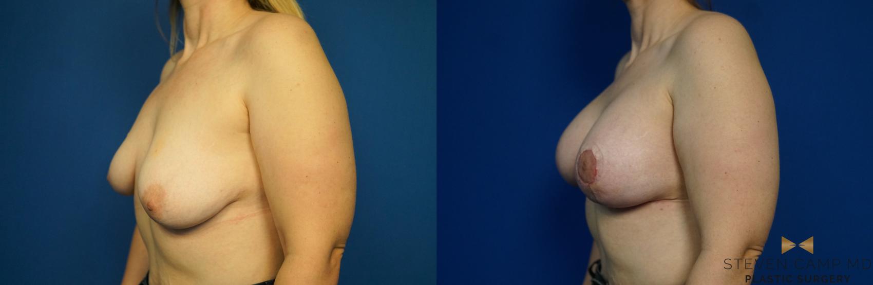 Before & After Breast Lift (Breast Mastopexy with Implants) Case 217 View #4 View in Fort Worth & Arlington, Texas