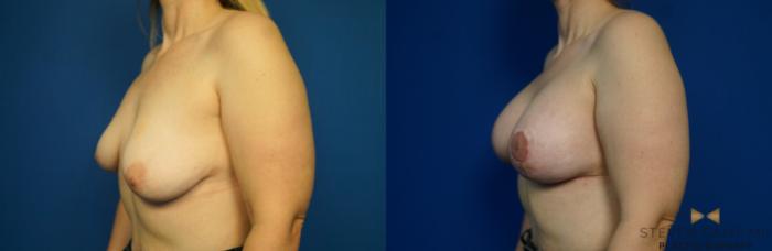 Before & After Breast Lift (Breast Mastopexy with Implants) Case 217 View #4 View in Fort Worth & Arlington, Texas