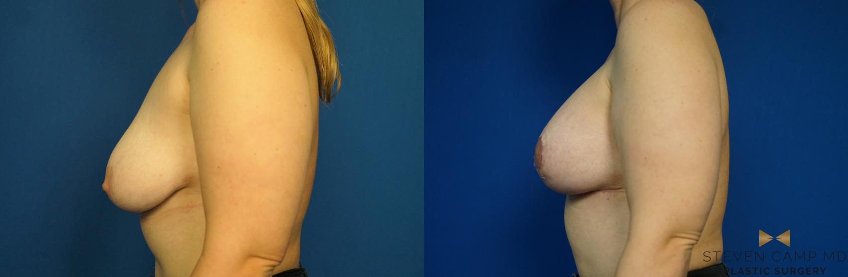 Before & After Breast Lift (Breast Mastopexy with Implants) Case 217 View #5 View in Fort Worth & Arlington, Texas