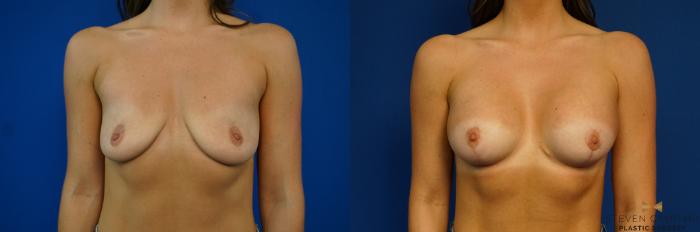 Before & After Breast Lift (Breast Mastopexy with Implants) Case 218 View #1 View in Fort Worth & Arlington, Texas