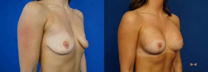 Before & After Breast Lift (Breast Mastopexy with Implants) Case 218 View #2 View in Fort Worth & Arlington, Texas