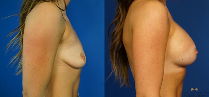 Before & After Breast Lift (Breast Mastopexy with Implants) Case 218 View #3 View in Fort Worth & Arlington, Texas