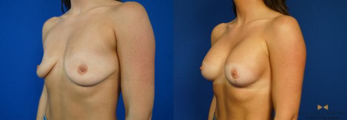 Before & After Breast Lift (Breast Mastopexy with Implants) Case 218 View #4 View in Fort Worth & Arlington, Texas