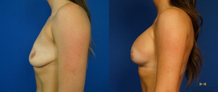 Before & After Breast Lift (Breast Mastopexy with Implants) Case 218 View #5 View in Fort Worth & Arlington, Texas