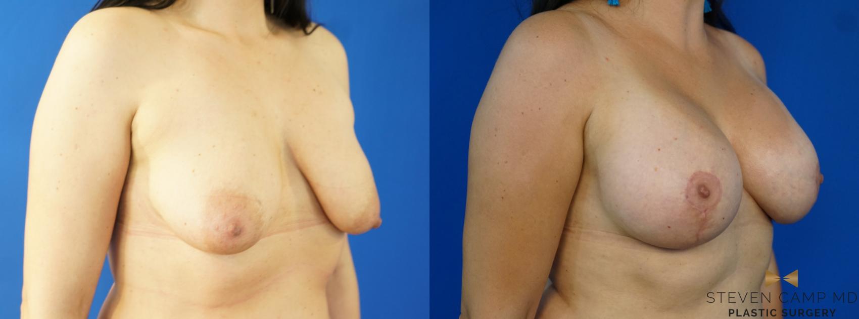 Before & After Breast Lift (Breast Mastopexy with Implants) Case 222 View #2 View in Fort Worth & Arlington, Texas