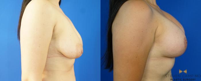 Before & After Breast Lift (Breast Mastopexy with Implants) Case 222 View #3 View in Fort Worth & Arlington, Texas