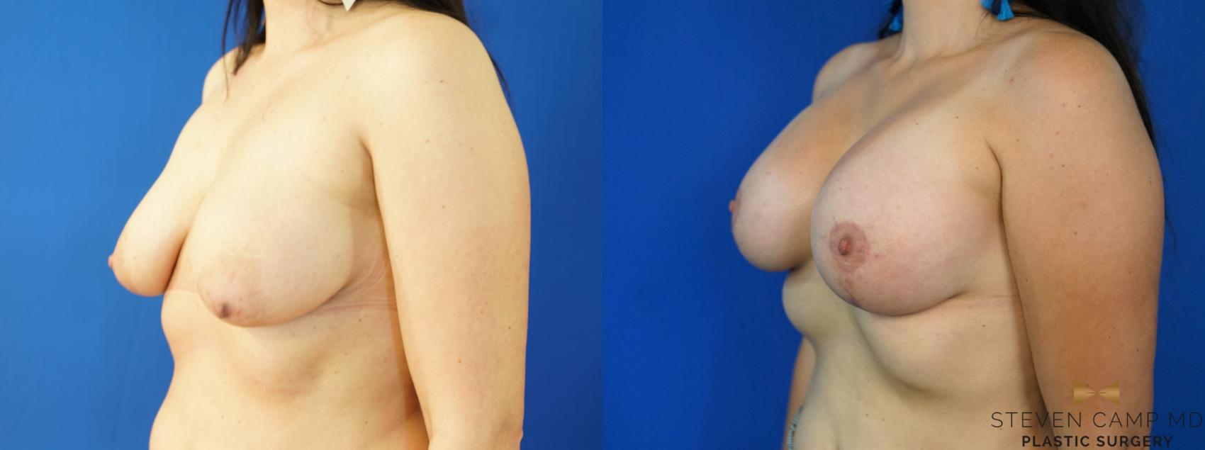 Before & After Breast Lift (Breast Mastopexy with Implants) Case 222 View #4 View in Fort Worth & Arlington, Texas