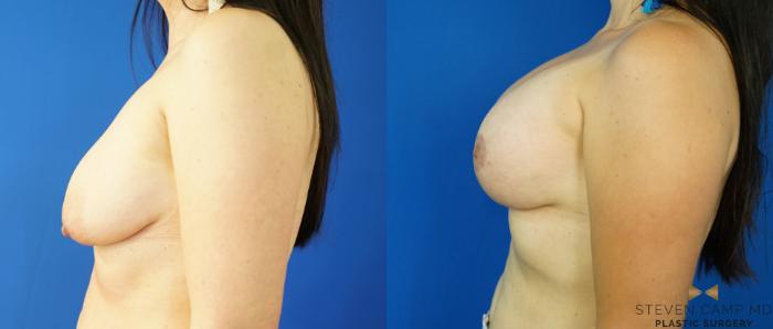 Before & After Breast Lift (Breast Mastopexy with Implants) Case 222 View #5 View in Fort Worth & Arlington, Texas