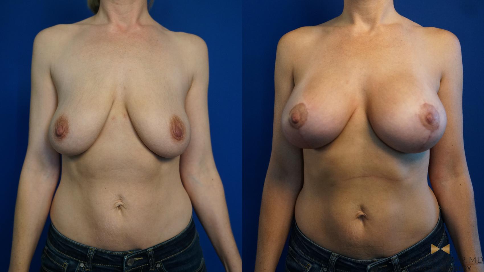 Before & After Breast Lift (Breast Mastopexy with Implants) Case 326 Front View in Fort Worth & Arlington, Texas