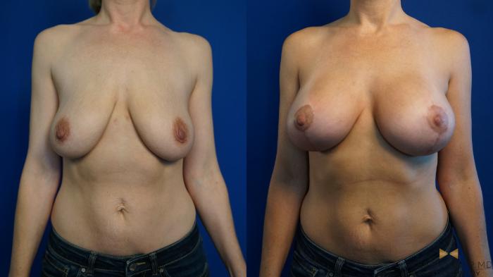 Before & After Breast Lift (Breast Mastopexy with Implants) Case 326 Front View in Fort Worth & Arlington, Texas