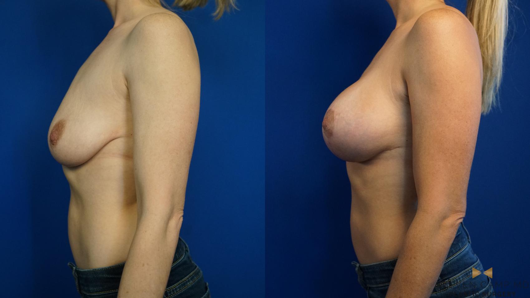 Before & After Breast Lift (Breast Mastopexy with Implants) Case 326 Left Side View in Fort Worth & Arlington, Texas