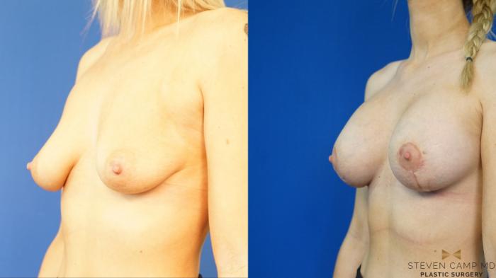 Before & After Breast Lift (Breast Mastopexy with Implants) Case 327 Left Oblique View in Fort Worth & Arlington, Texas