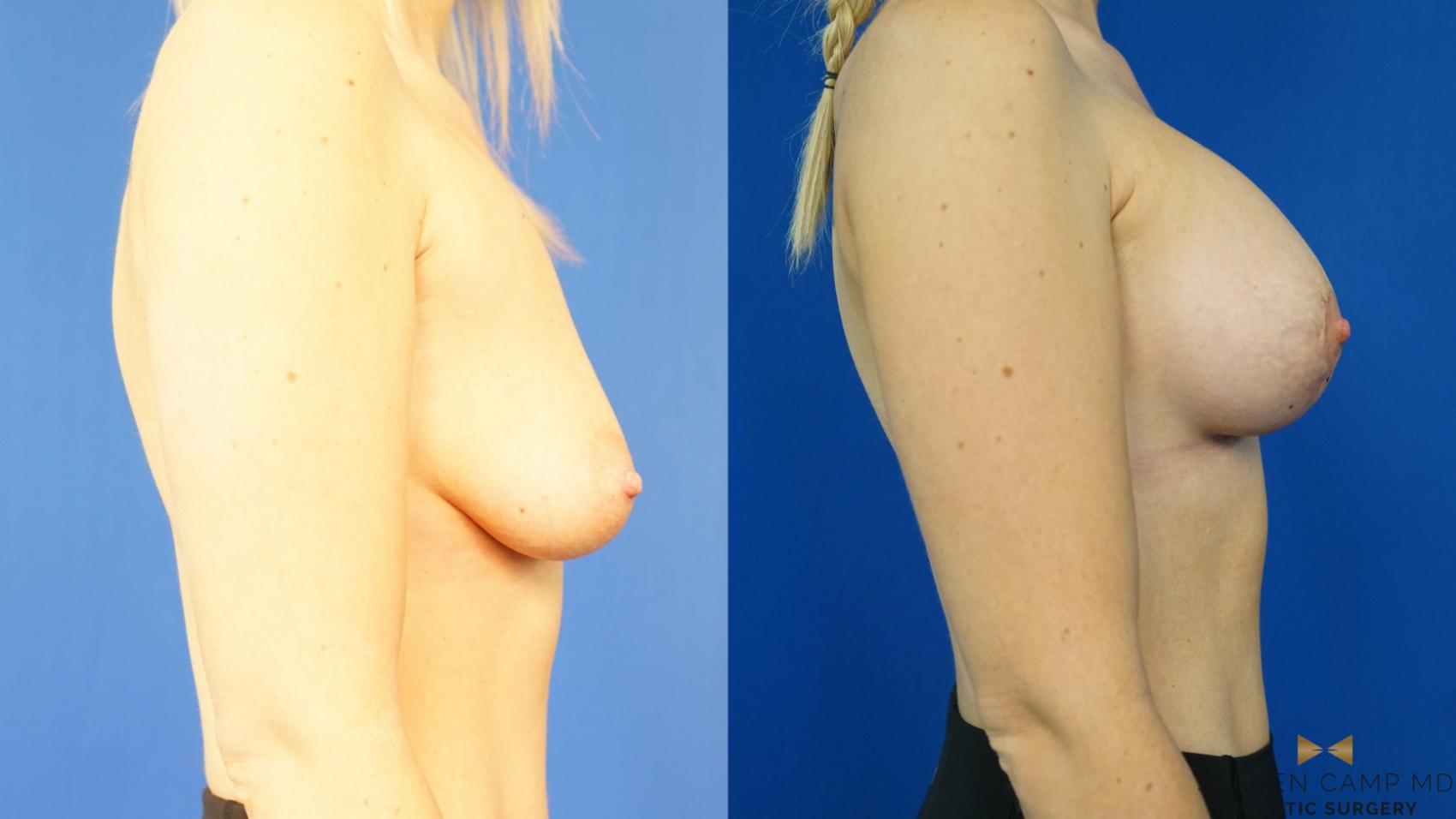 Before & After Breast Lift (Breast Mastopexy with Implants) Case 327 Right Side View in Fort Worth & Arlington, Texas