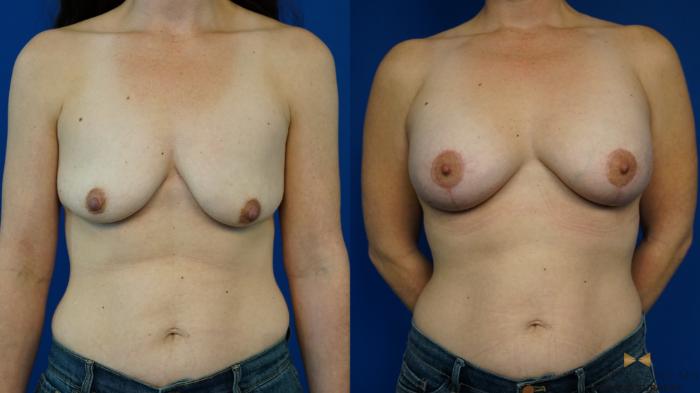 Before & After Breast Lift (Breast Mastopexy with Implants) Case 341 Front View in Fort Worth & Arlington, Texas