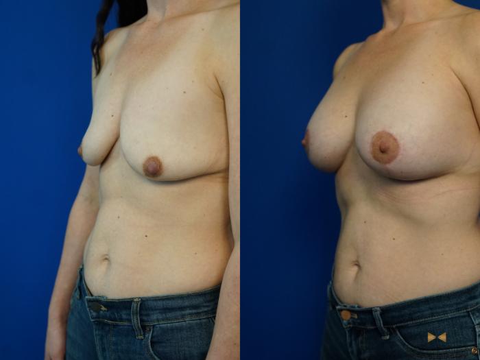 Before & After Breast Lift (Breast Mastopexy with Implants) Case 341 Left Oblique View in Fort Worth & Arlington, Texas