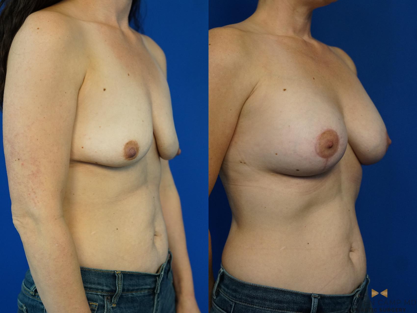 Before & After Breast Lift (Breast Mastopexy with Implants) Case 341 Right Oblique View in Fort Worth & Arlington, Texas