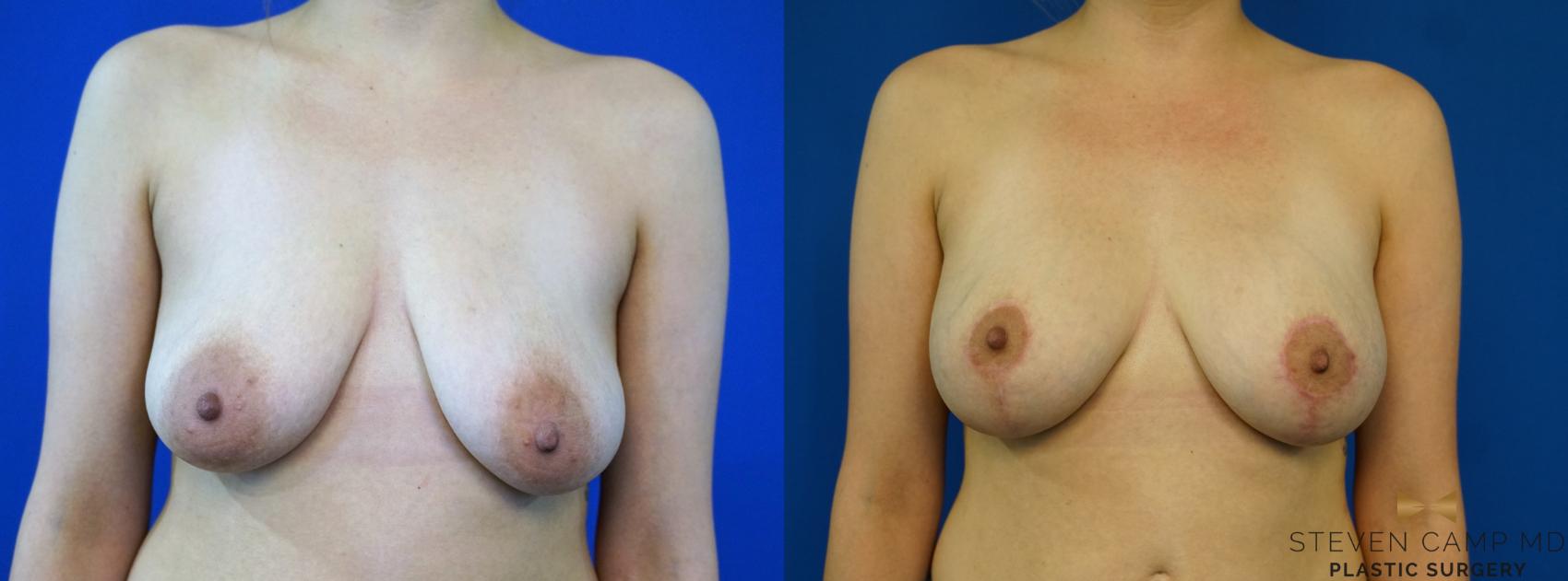 Before & After Breast Lift (Breast Mastopexy with Implants) Case 346 Front View in Fort Worth & Arlington, Texas