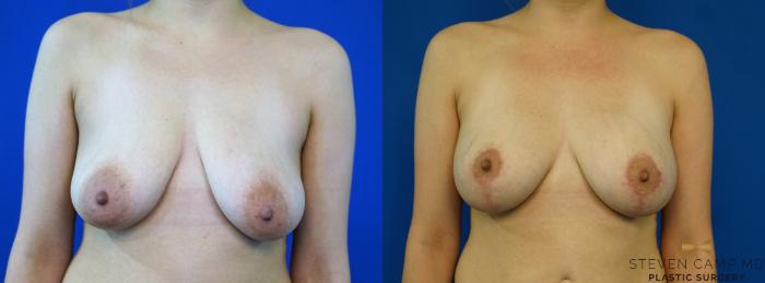 Before & After Breast Lift (Breast Mastopexy with Implants) Case 346 Front View in Fort Worth & Arlington, Texas