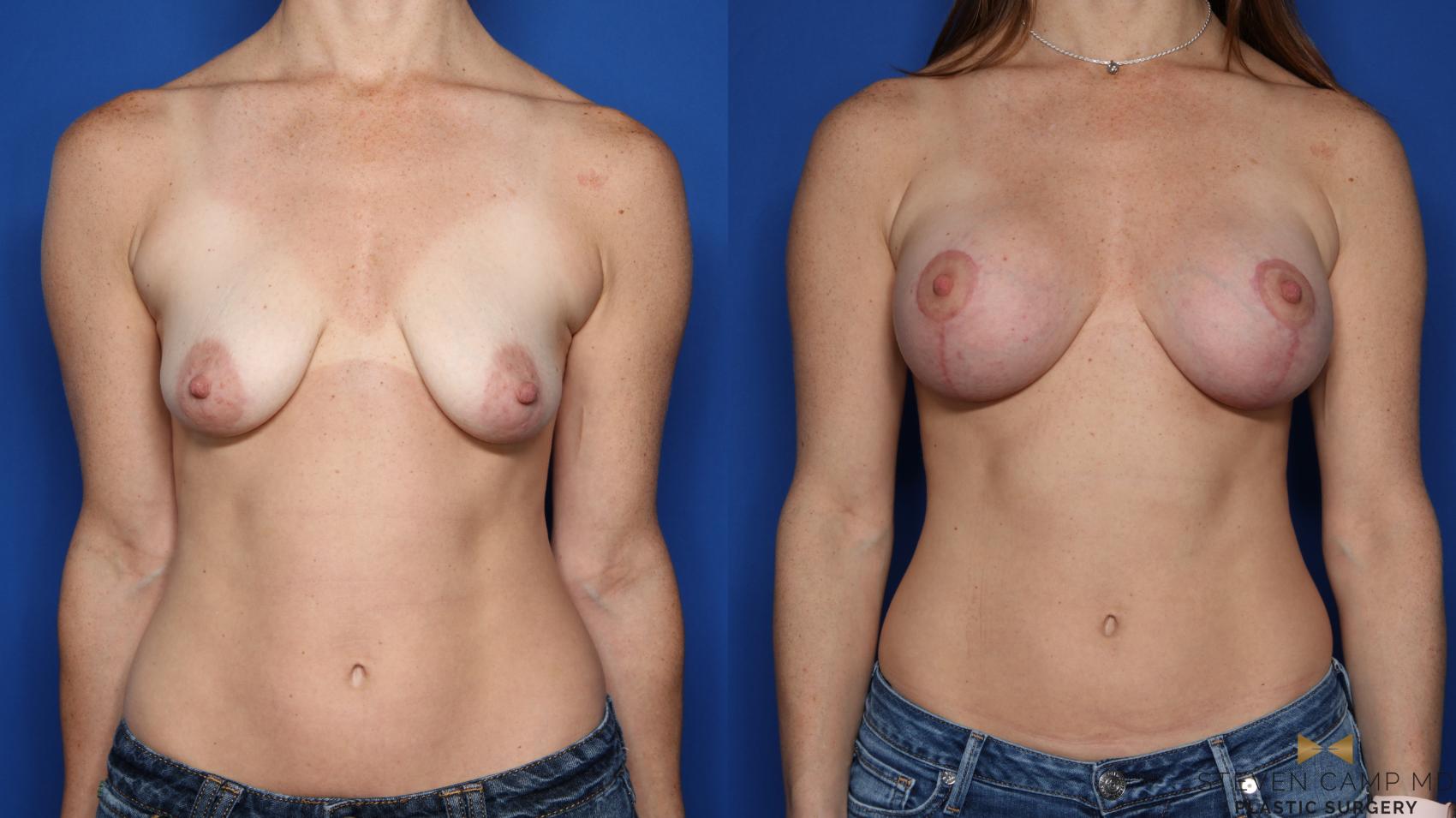 Before & After Breast Lift (Breast Mastopexy with Implants) Case 348 Front View in Fort Worth & Arlington, Texas