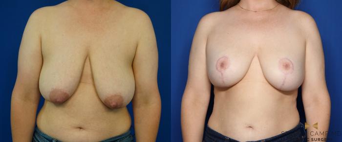 Before & After Breast Lift (Breast Mastopexy with Implants) Case 352 Front View in Fort Worth & Arlington, Texas