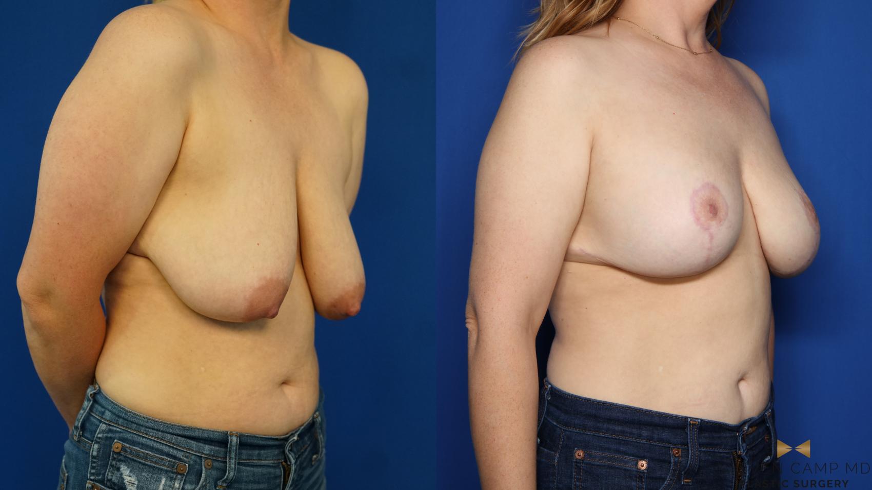 Before & After Breast Lift (Breast Mastopexy with Implants) Case 352 Right Oblique View in Fort Worth & Arlington, Texas