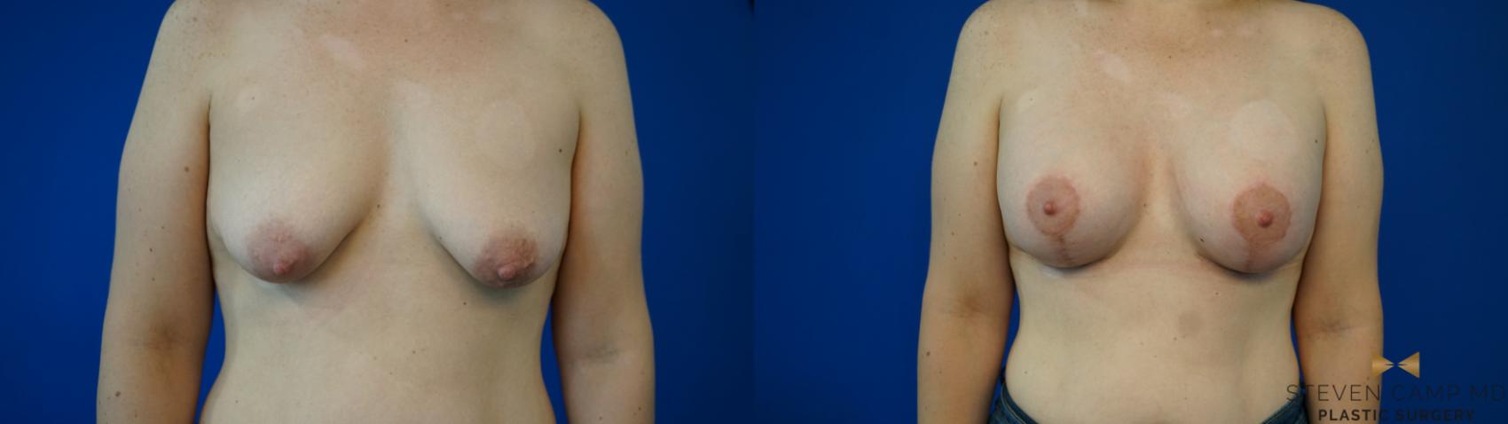 Before & After Breast Lift (Breast Mastopexy with Implants) Case 353 Front View in Fort Worth & Arlington, Texas